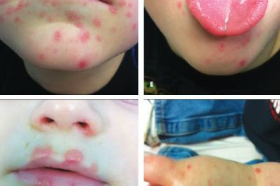 HFMD  infects over 1,000 kids in Iloilo