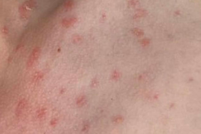 Psoriasis not contagious, must not cause stigma